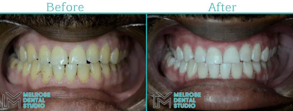 Teeth whitening before and after result, case 2, Melrose Dental Studio